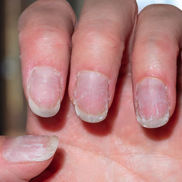 esmalte-em-gel Unhas enfraquecidas e quebradas após remoção errada do esmalte em gel